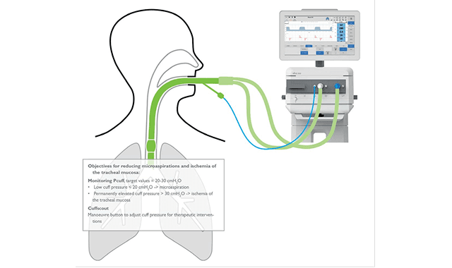Elisa Ventilator l เทคโนโลยี Cuffscout ที่ช่วยวัดและรักษาระดับแรงดันภายใน Cuff