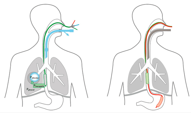 Elisa Ventilator l การวัดแรงดันในปอดผ่านการวัดแรงดันหลอดอาหาร